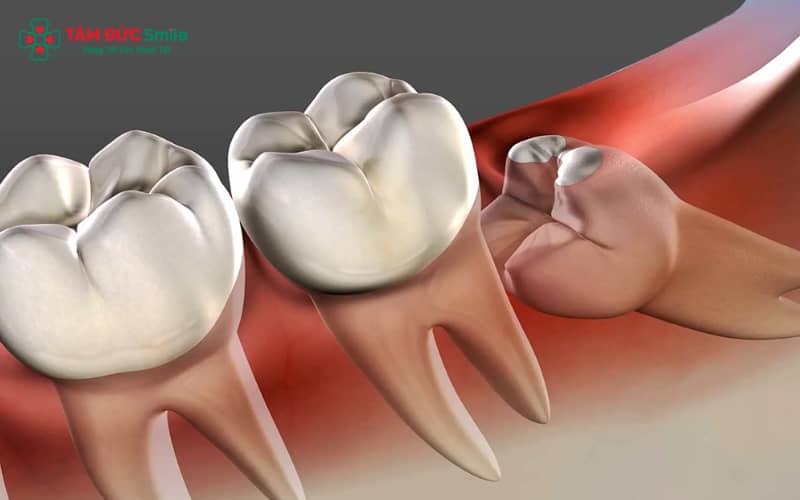 Răng khôn khi mọc bất thường có thể rơi vào tình trạng lệch, ngầm hoặc kẹt