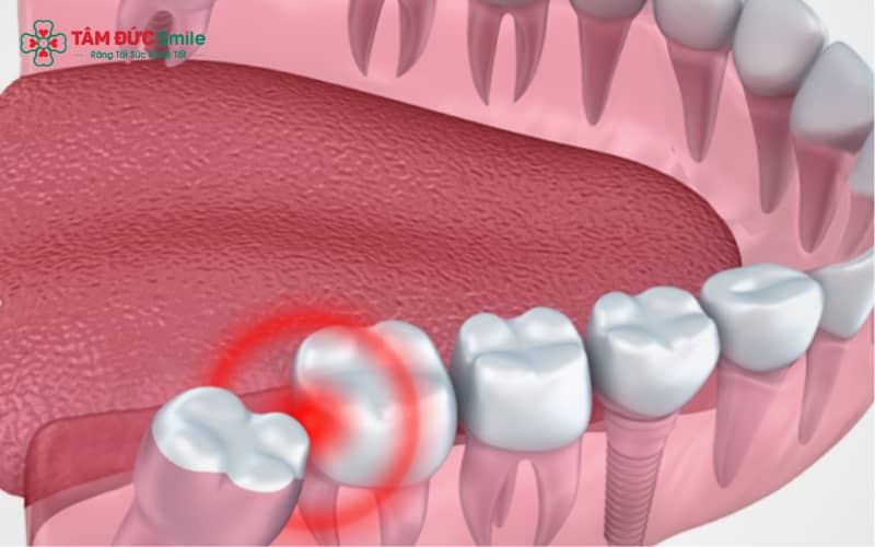 Răng khôn mọc lệch về phía má thường gây ma sát, dẫn đến cảm giác cộm, đau và khó chịu