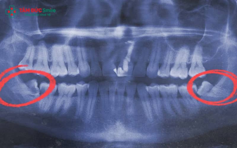 Tình trạng răng khôn mọc lệch ra má không chỉ gây đau và loét miệng mà còn làm tăng nguy cơ viêm nướu, sâu răng