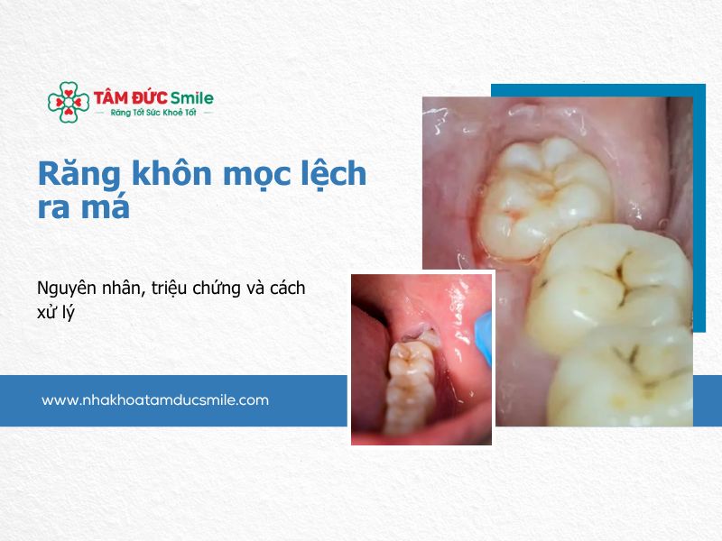 rang-khon-moc-lech-ra-ma-5