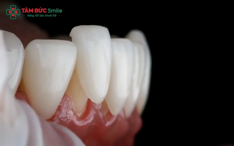 Răng sứ thẩm mỹ giúp tái tạo nụ cười hoàn hảo, khôi phục hình thể và bảo vệ răng gốc tối ưu