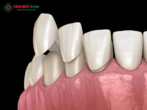 Răng sứ thẩm mỹ là gì? Các loại, bảng giá và quy trình bọc răng sứ