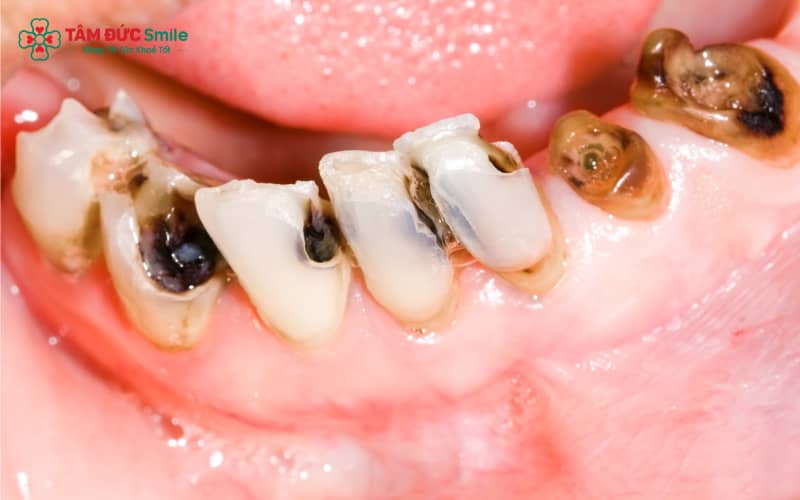 Sâu răng là bệnh lý thường gặp trong nha khoa