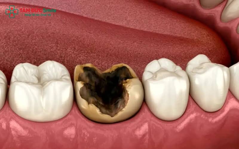 Sâu răng hình thành chủ yếu do vi khuẩn, thói quen ăn uống không hợp lý và vệ sinh răng miệng kém