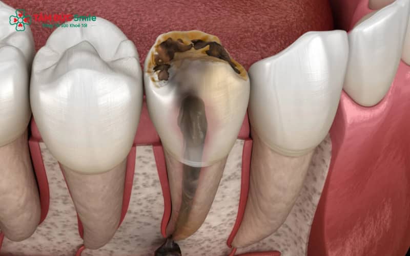 Giai đoạn nặng của sâu răng đặc trưng bởi lỗ sâu lớn, đau nhức kéo dài và viêm nhiễm nướu