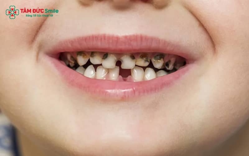 Vi khuẩn Streptococcus mutans cùng với mảng bám thức ăn là tác nhân chính gây sâu răng và làm trẻ bị đau nhức