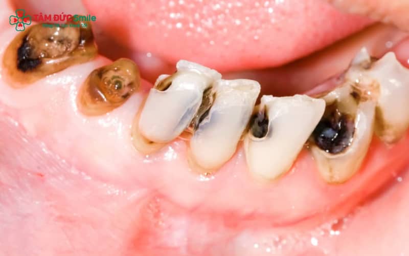Khi bị sâu răng, trẻ thường đau nhức, biếng ăn, ăn uống khó khăn, từ đó làm ảnh hưởng đến sự phát triển thể chất