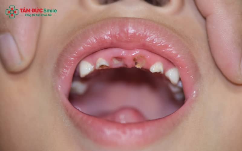 Một chế độ dinh dưỡng cân đối và vệ sinh răng miệng đúng cách là nền tảng quan trọng trong việc bảo vệ răng miệng của trẻ