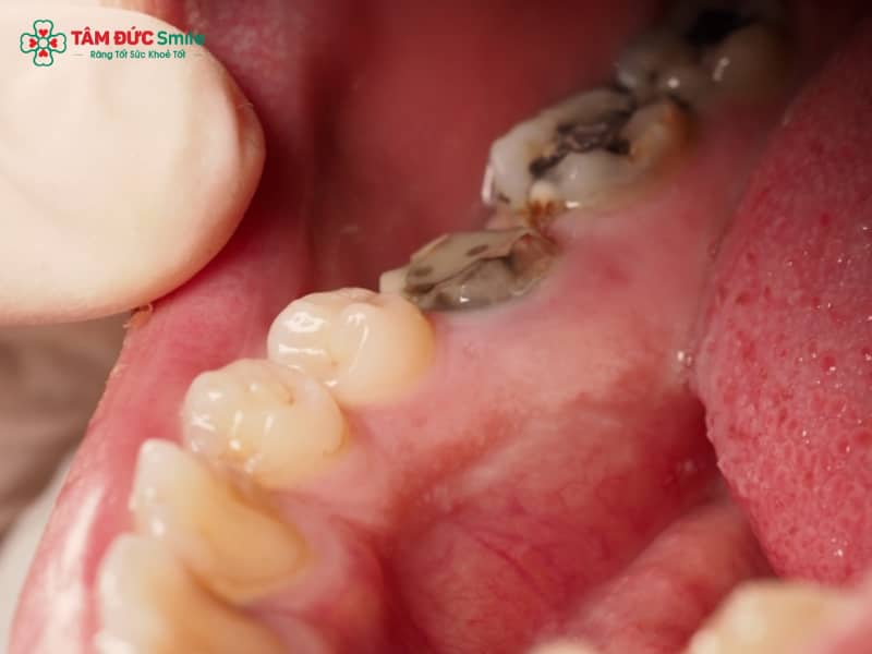 Sâu răng: Nguyên nhân, triệu chứng, biến chứng và cách điều trị hiệu quả