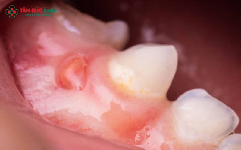 Khi chân răng bị sưng, đây có thể là dấu hiệu tiềm ẩn cho thấy nướu đang bị viêm hoặc nhiễm trùng