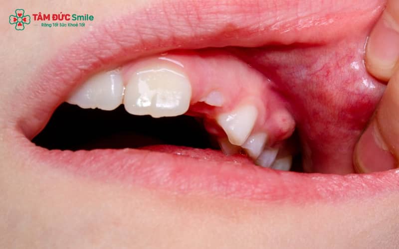 Sưng chân răng là hiện tượng nướu bị viêm nhiễm và phù nề do sự xâm nhập của vi khuẩn