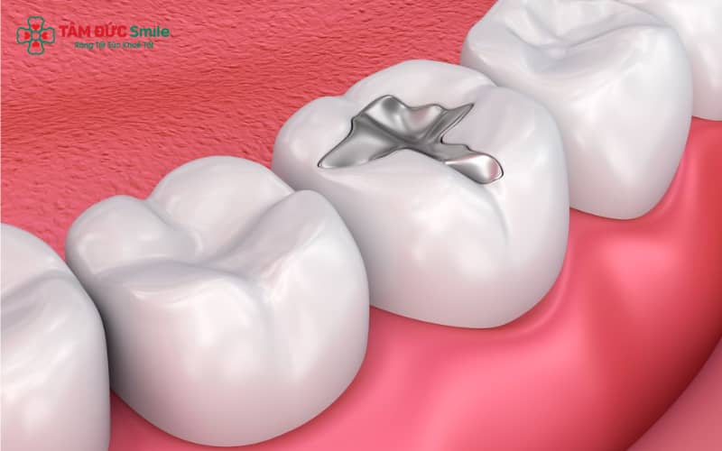 Trám răng là phương pháp phục hình đơn giản, sử dụng vật liệu nhân tạo để che lấp phần răng bị mất do sâu hoặc nứt mẻ