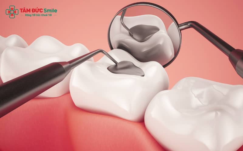 Trám răng hiện đại giúp bệnh nhân gần như không cảm thấy đau nhờ kỹ thuật gây tê cục bộ hiệu quả