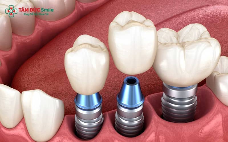 Sau giai đoạn 1 tháng hồi phục, hầu hết bệnh nhân có thể ăn thử thịt gà vì vết thương đã ổn định