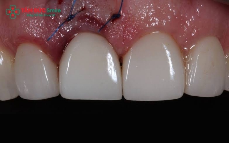 Implant răng cửa giúp khôi phục nụ cười tự nhiên mà không gây hại cho răng kế cận.