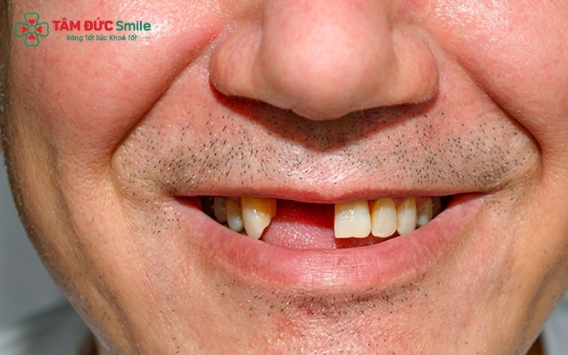 Phục hình Implant giúp lấy lại thẩm mỹ và chức năng ăn nhai tối ưu cho người mất răng cửa.