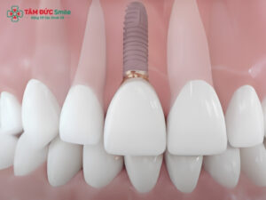 Trồng Implant răng cửa là gì? Quy trình trồng Implant răng cửa tại Nha khoa
