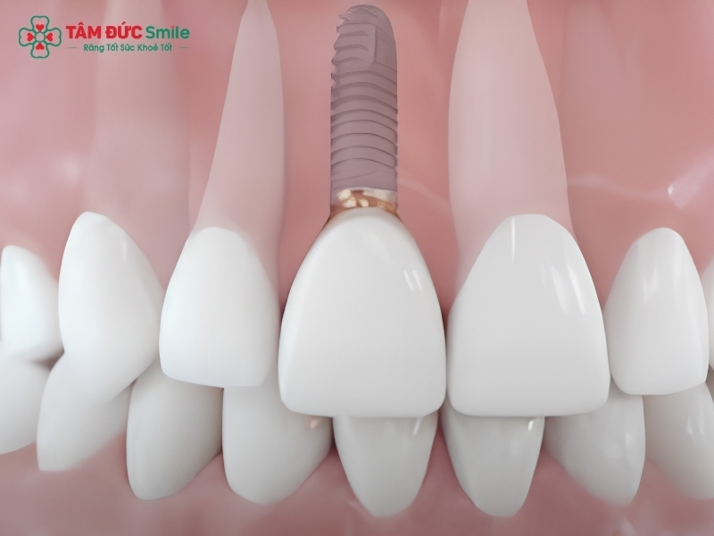 Trồng Implant răng cửa là gì? Quy trình trồng Implant răng cửa tại Nha khoa