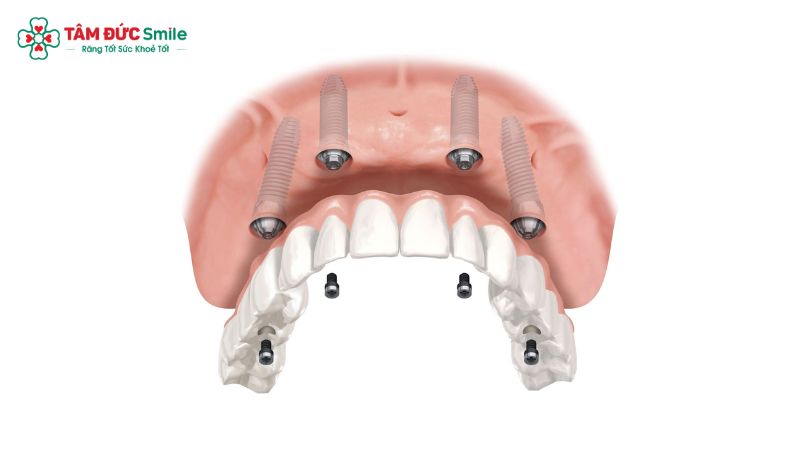 trong-rang-implant-all-on-4-2