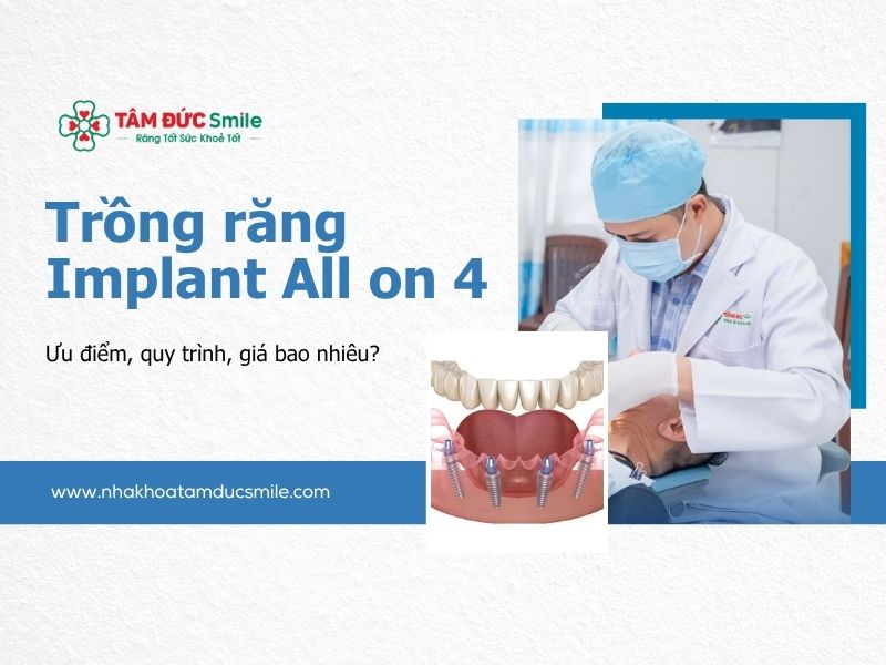 trong-rang-implant-all-on-4