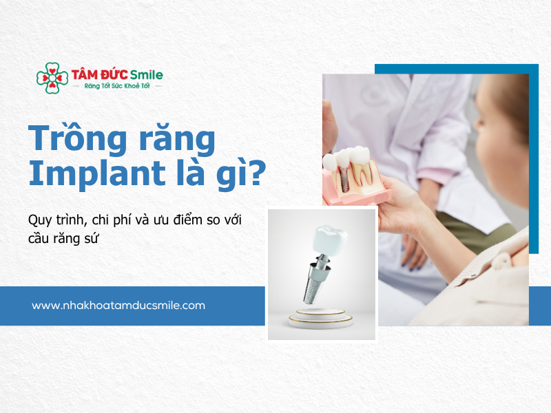 trong-rang-implant