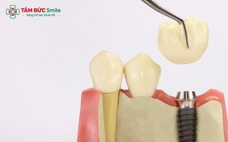 Cấu tạo của một chiếc răng Implant hoàn chỉnh tại Nha khoa Tâm Đức Smile.
