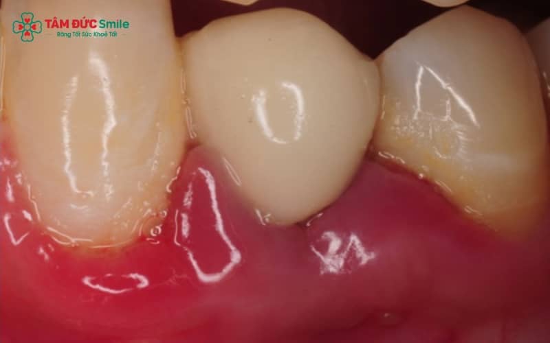 Viêm quanh Implant thường biểu hiện bằng tình trạng nướu đỏ, sưng viêm và có hiện tượng chảy máu