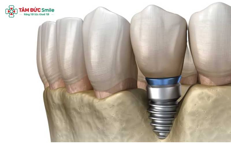 Đối với viêm quanh Implant có tiêu xương, bác sĩ thường ứng dụng công nghệ laser để tiêu diệt vi khuẩn hiệu quả