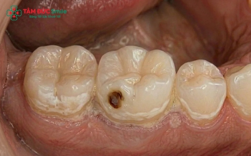 Sâu răng không điều trị và chấn thương là những "thủ phạm" chính gây viêm tủy răng.
