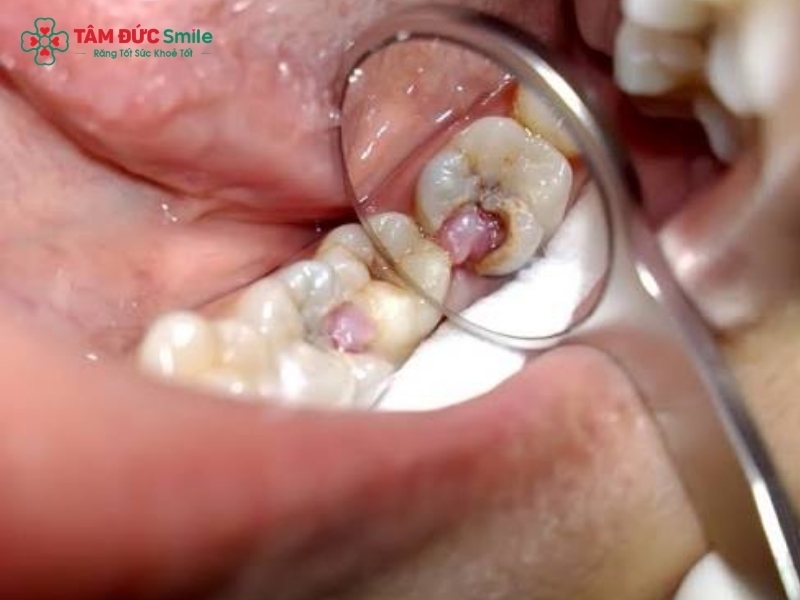 Viêm tủy răng: Dấu hiệu, nguyên nhân, ảnh hưởng và điều trị hiệu quả