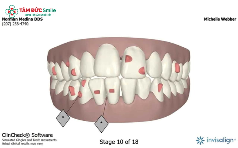 ClinCheck là công cụ mô phỏng hình ảnh 3D chuyên biệt