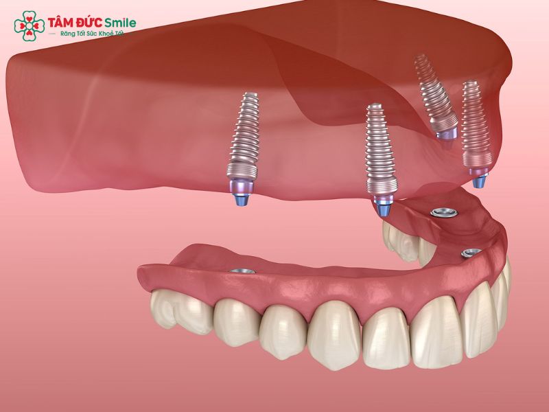 ham-thao-lap-tren-implant-1