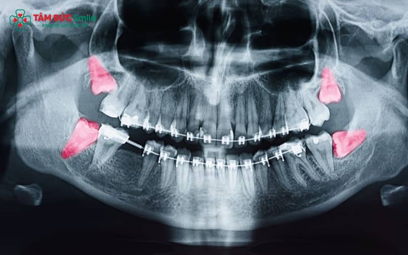 Hàm răng 28 chiếc vẫn được coi là khỏe mạnh và đảm bảo tốt chức năng nhai