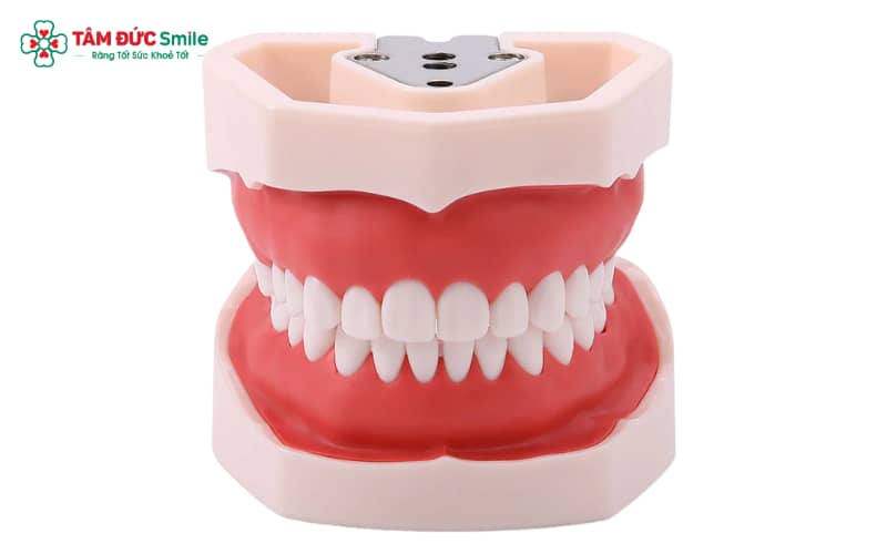 Việc chỉ có 28 chiếc răng thường liên quan đến sự vắng mặt bẩm sinh của răng khôn