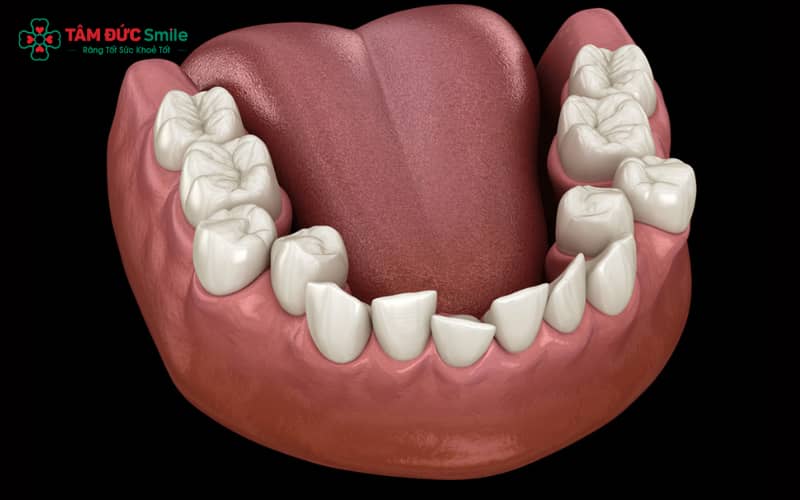 Tình trạng mọc răng quá số lượng chuẩn, khiến một số người có tới 36 răng