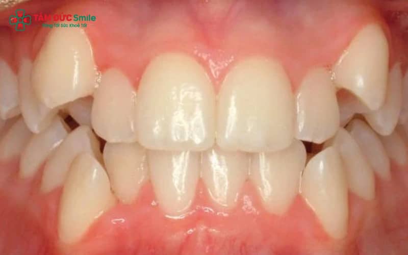 Răng mọc thừa có thể xuất hiện rải rác trong cung hàm, đa phần có hình thể bất thường
