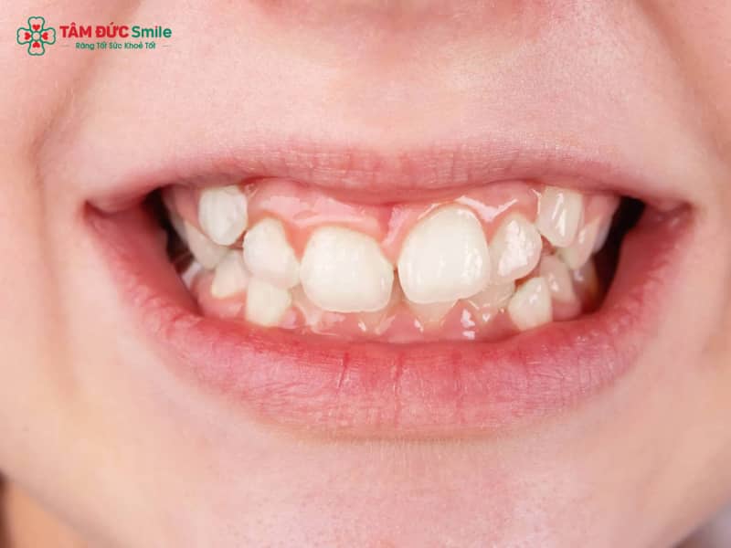 Chỉnh nha giúp sắp xếp lại hàm răng, cải thiện tình trạng mọc dư đến 36 răng