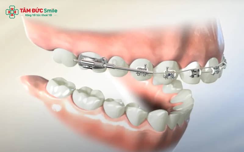 Niềng một hàm chỉ được chỉ định cho những trường hợp răng lệch nhẹ, đảm bảo khớp cắn chuẩn sau khi kết thúc điều trị