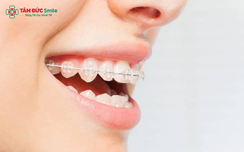 Chỉnh nha 2 hàm điều chỉnh cả hàm trên và hàm dưới cùng lúc, đảm bảo hiệu quả toàn diện về khớp cắn và thẩm mỹ