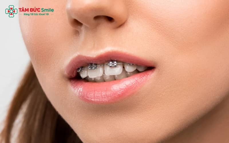 Răng hô nhẹ xảy ra khi răng mọc lệch, khiến hàm trên hơi đưa ra phía trước