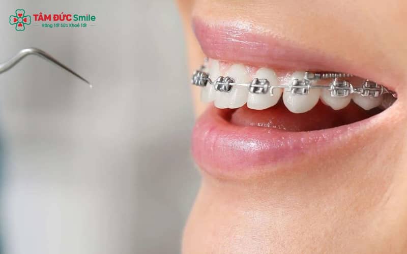 Niềng răng mắc cài điều chỉnh răng hô nhẹ thông qua lực tác động của dây cung gắn trên các mắc cài, đưa răng về vị trí chuẩn