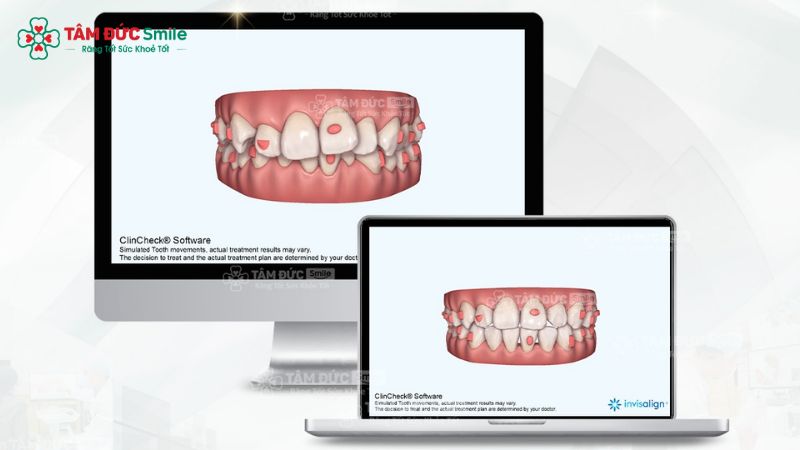 Khay Invisalign được thiết kế cá nhân hóa, giúp răng dịch chuyển từng bước theo phác đồ tại Nha khoa Tâm Đức Smile.