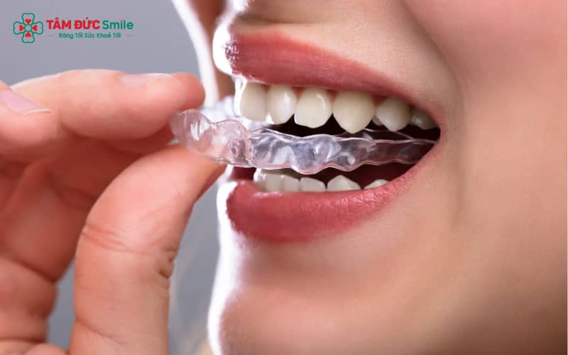 Khay niềng nhựa trong suốt với độ đàn hồi cao là nền tảng của phương pháp niềng răng nhựa