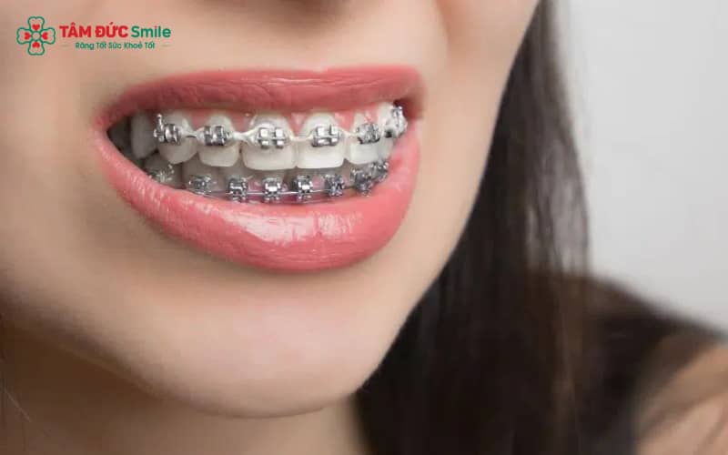 Niềng răng truyền thống bằng mắc cài kim loại kết hợp mắc cài cố định và dây cung chạy trong rãnh mắc cài