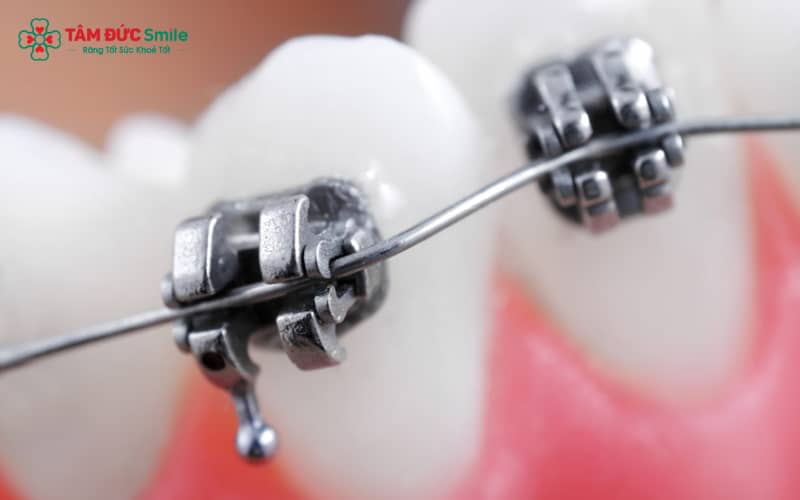Niềng răng kim loại tự buộc hoạt động mà không cần dây thun như mắc cài truyền thống