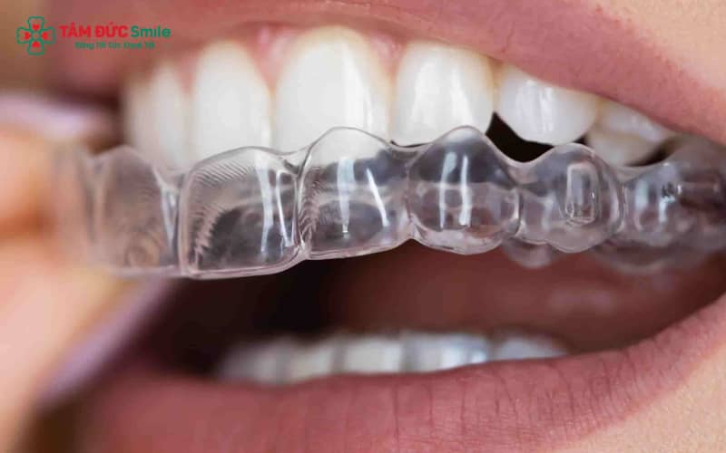 Hiệu quả của niềng răng trong suốt được minh chứng qua nhiều nghiên cứu và kinh nghiệm thực tế