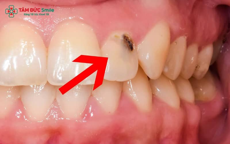 Giai đoạn sâu răng sớm xảy ra khi mảng bám và vi khuẩn tích tụ, dần phá hủy cấu trúc men răng ban đầu