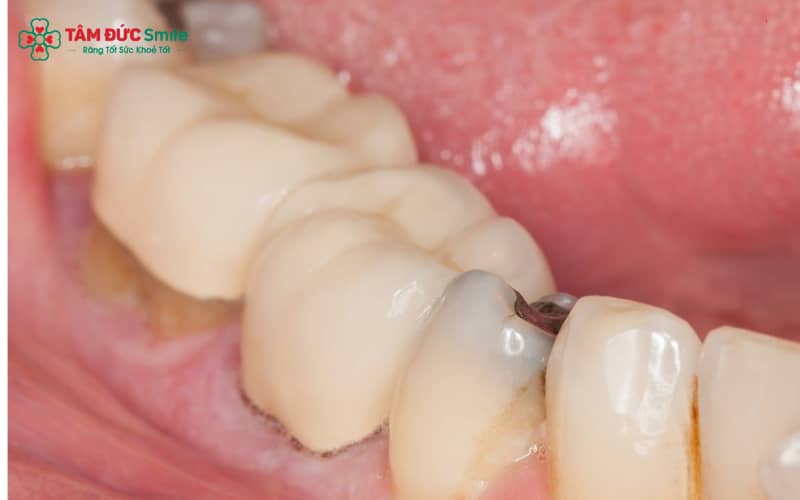 Khi sâu răng mới hình thành, men răng bắt đầu mất khoáng, tạo nên các đốm màu trắng đục hay nâu nhạt trên bề mặt