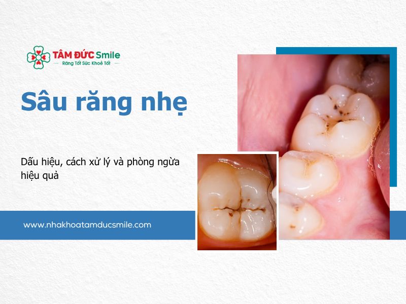 sau-rang-nhe-5