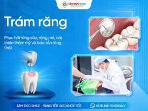 Trám răng là gì? Chi phí, Lợi ích, Quy trình và Địa chỉ uy tín